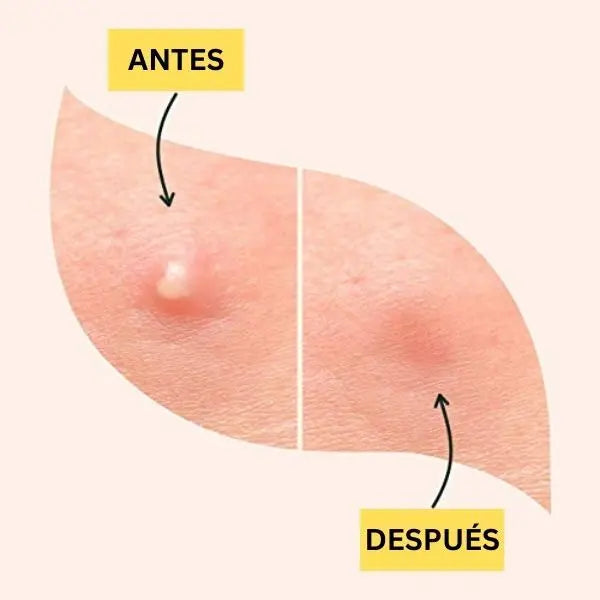 ClearSkin® | El secreto invisible para eliminar granitos sin marcas x36